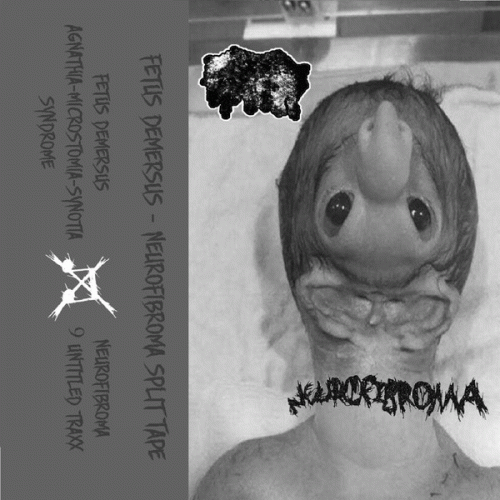 Fetus Demersus : Fetus Demersus - Neurofibroma